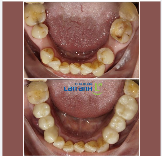 Phục hồi lại răng mất bằng phương pháp cầu răng sứ