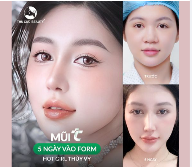 Tạm biệt sống mũi thấp, đầu mũi to chỉ 30P