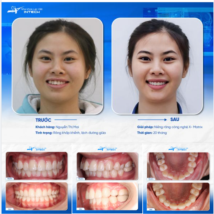 KHÔNG CÒN TỰ TI VÌ RĂNG HÔ, NỮ KHÁCH HÀNG GẶT HÁI NHIỀU THÀNH CÔNG TRONG CÔNG VIỆC!