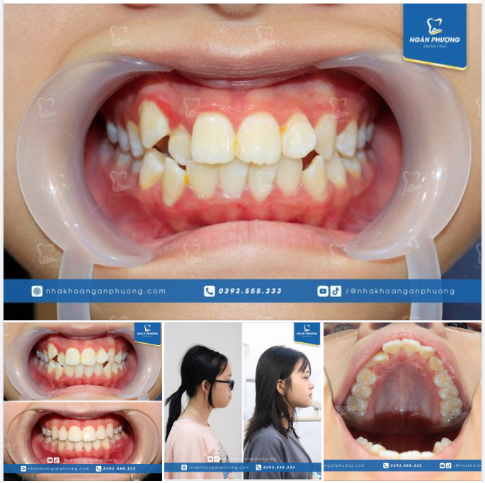 Niềng răng sớm có lợi như thế nào?