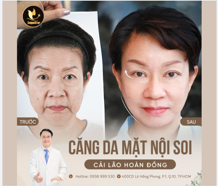 Chọn CĂNG DA MẶT NỘI SOI – Cải lão hoàn đồng - Lấy lại tuổi xuân