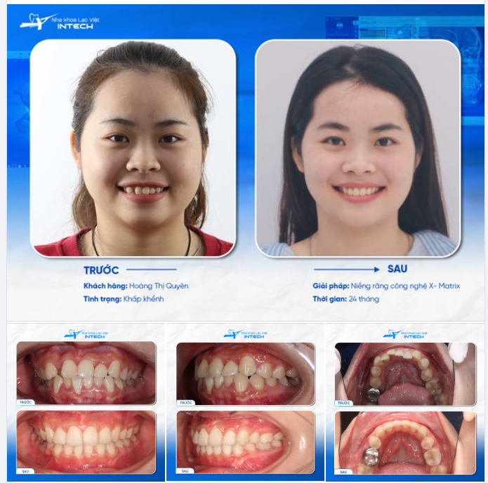 TRẺ HƠN 1O TUỔI NHỜ NIỀNG RĂNG LÀ CÓ THẬT? ​​​​​​​ KIỂM CHỨNG NGAY!