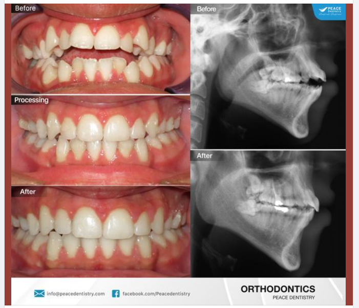 CHỈNH NHA INVISALIGN NHỮNG CA PHỨC TẠP, ĐỘ KHÓ CAO