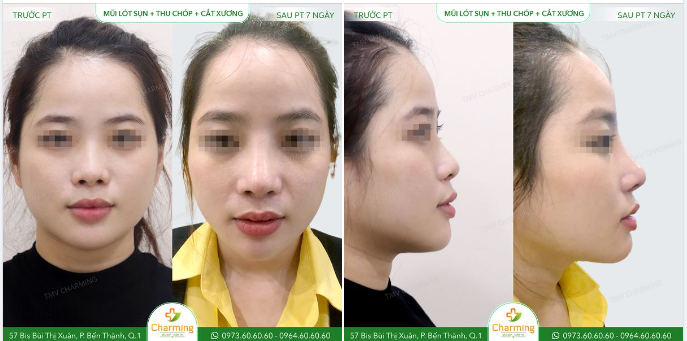 Một chiếc mũi với sóng mũi không cao, đầu mũi to bè và dáng mũi thô sẽ khiến mọi người bớt đi sự tự tin của chính mình.