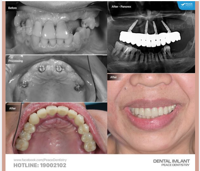 XEM XÉT KẾ HOẠCH CẤY IMPLANT TỪ SỚM SẼ MANG LẠI RẤT NHIỀU LỢI ÍCH CHO KHÁCH HÀNG!