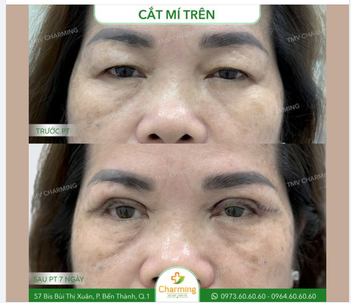 Một đôi mắt với phần mí trên bị sụp, da chùng nhiều sẽ khiến gương mặt bạn như được cộng thêm vài tuổi và thậm chí là hạn chế tầm nhìn của bạn.