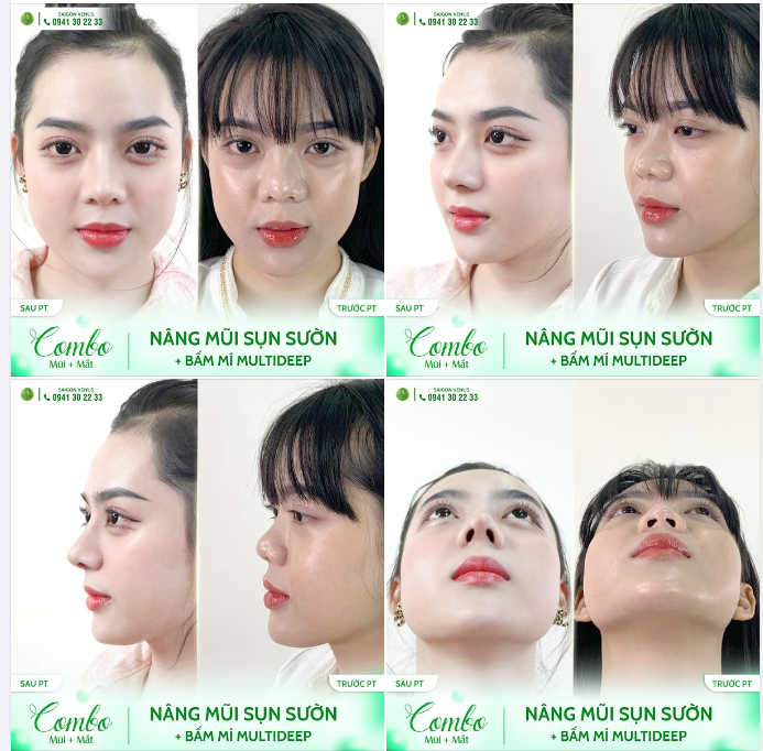 COMBO MŨI MÍ, THAY ĐỔI NHƯ Ý