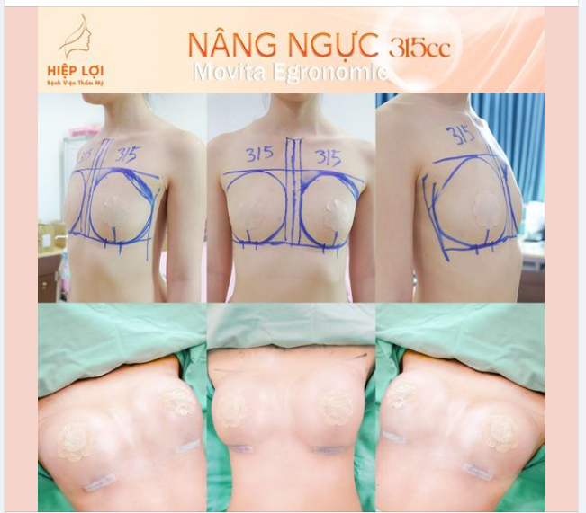 Nâng ngực an toàn, túi ngực chất lượng và bác sĩ chuyên khoa tay nghề cao, nhiều khách hàng đã thay đổi diện mạo và tự tin hơn với vòng 1 lý tưởng.