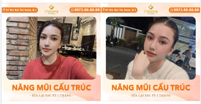TOP 5 ĐIỀU BẠN KHÔNG ĐƯỢC QUÊN SAU KHI NÂNG MŨI