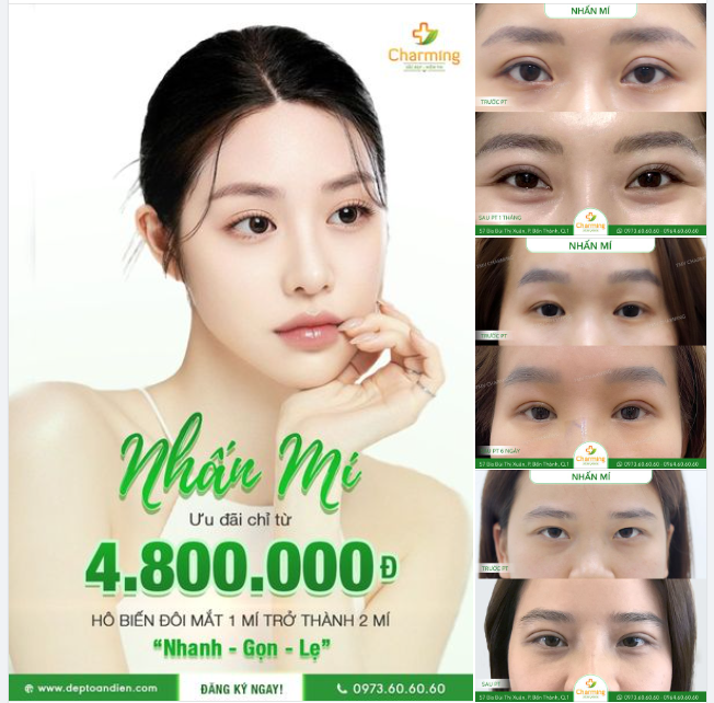 NHẤN MÍ - ƯU VÀ KHUYẾT ĐIỂM CỦA LOẠI HÌNH PHẪU THUẬT NÀY