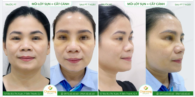 Mũi ngắn lại đánh một chiếc võng thật lớn, thêm một đôi cánh mũi to dễ làm cho khuôn mặt thêm phần to bè.