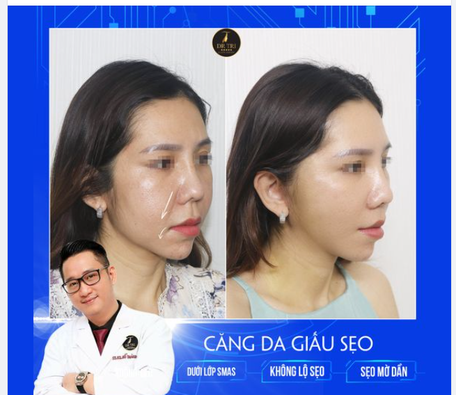 TẠM BIỆT RÃNH CƯỜI SÂU SAU 14 NGÀY