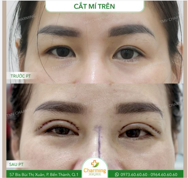 Đôi mắt vốn hai mí nhưng mí trên lại muốn "tranh sủng", lấn lướt mí dưới quá nhiều. Đôi đường mí không còn đều đặn mà bên thấp, bên cao.