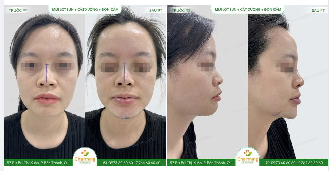Khuôn mặt đã ngắn nên nâng mũi có đẹp cũng không thể nào giữ cho khuôn mặt thanh tú, hài hòa được.