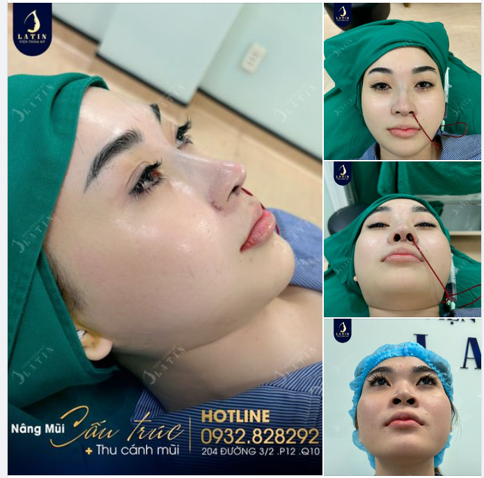Nâng mũi cấu trúc - Hoá phép mọi khuyết điểm mũi thành ưu điểm bật nét gương mặt