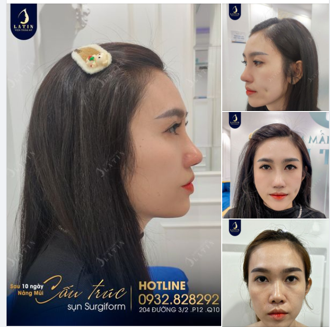 Chị gái tái khám combo sau 10 ngày