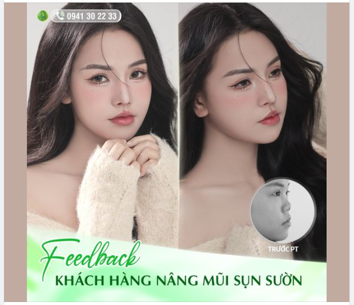 FEEDBACK THAY ĐỔI TOÀN DIỆN SAU NÂNG MŨI SỤN SƯỜN
