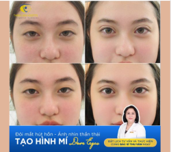 Sau 30 phút, bạn gái đã sở hữu đôi mắt 2 mí to rõ ngay sau tạo hình mắt 2 mí tại Thanh Vân Hospital!