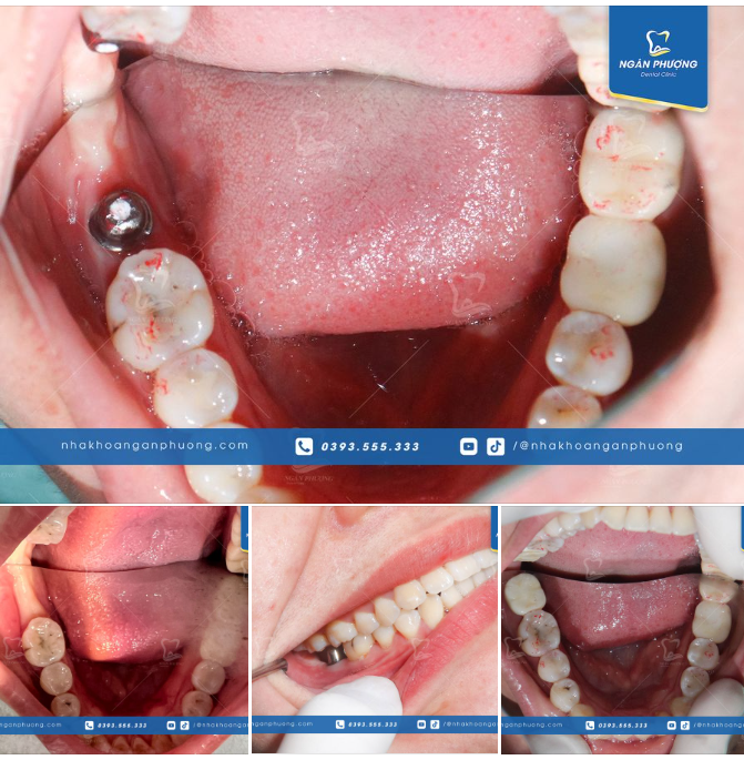 Mấy vết đỏ đỏ trên răng, ai chăm qua nha khoa nhìn cái hiểu luôn