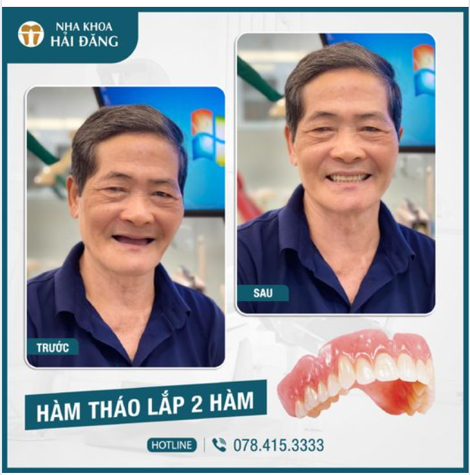 HÀM GIẢ THÁO LẮP GIẢI PHÁP CHO NGƯỜI MẤT NHIỀU RĂNG