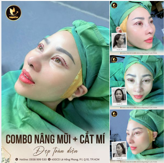 COMBO ĐẸP TOÀN DIỆN: NÂNG MŨI + CẮT MÍ