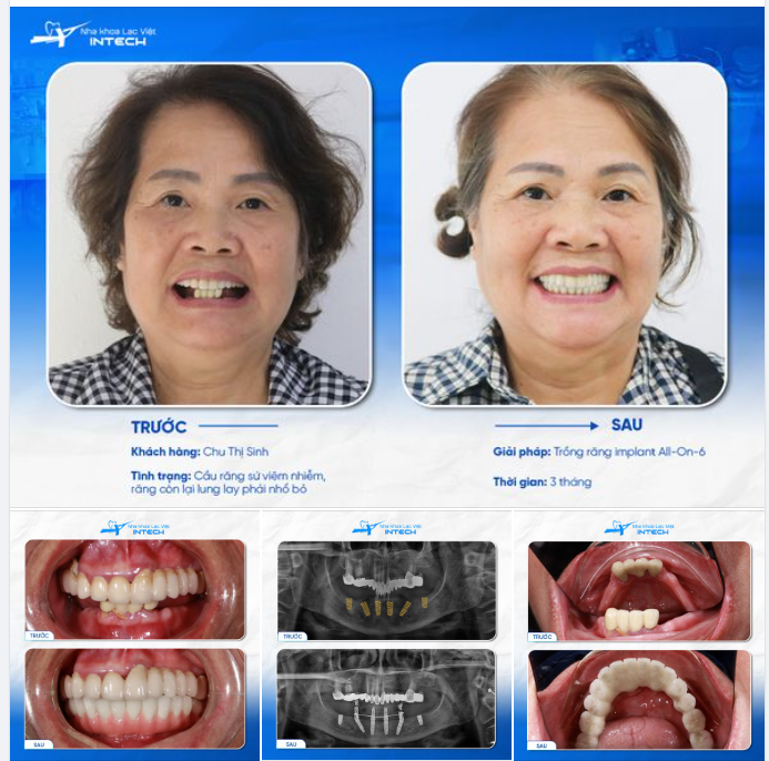 MẤT TOÀN BỘ RĂNG HÀM DƯỚI VÌ CẦU RĂNG SỨ