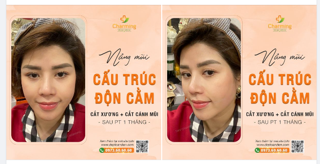 Nếu mọi người vẫn còn lăn tăn không biết nâng mũi và độn cằm có cùng thực hiện được hay không thì nàng khách của Charming đây là câu trả lời thực tế