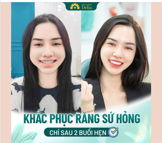 48H Bọc răng sứ Thay đổi toàn diện nụ cười cho chị Thu Trang khắc phục các tình trạng:
