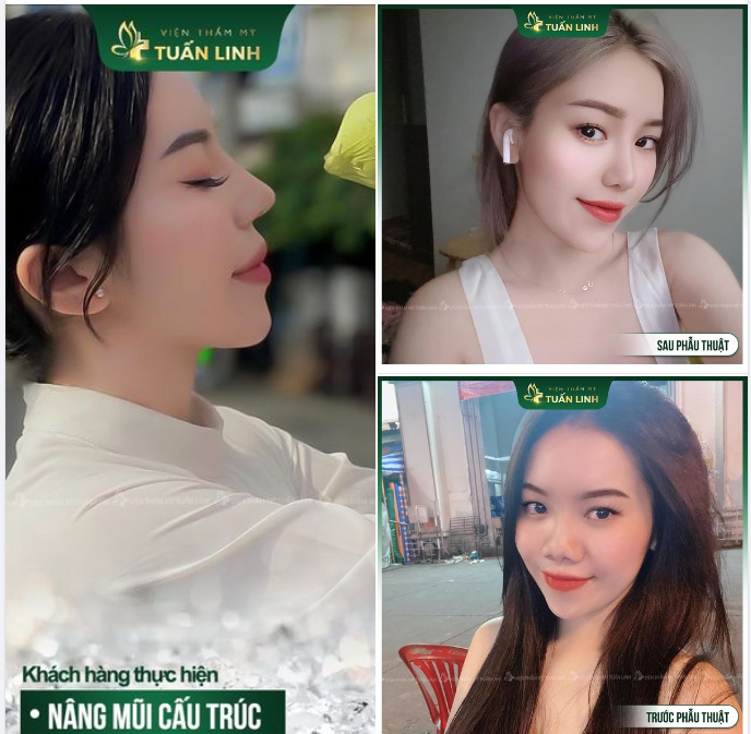 Mũi thấp tẹt, cánh mũi to bè, xòe rộng làm gương mặt bạn thiếu tinh tế, thiếu độ hài hòa cân đối cần có.