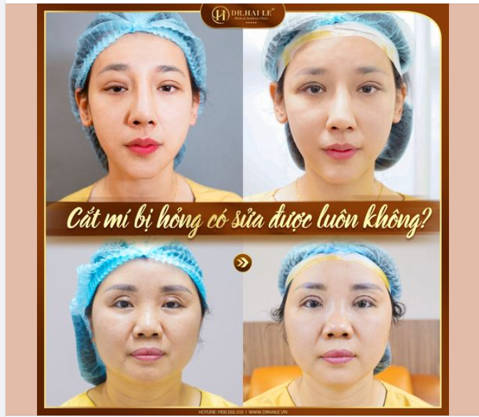 Cắt mí hỏng có sửa lại được không?