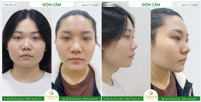 Ngày xưa, mặt vuông chữ điền là một nét quý và đẹp, biểu hiện cho chính nhân quân tử. Nhưng khuôn mặt chữ điền ở phụ nữ giờ đây lại khiến khuôn mặt kém xinh bởi đường nét quá cứng và thô.