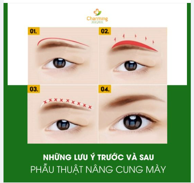 LƯU Ý TRƯỚC VÀ SAU KHI THỰC HIỆN NÂNG CUNG MÀY