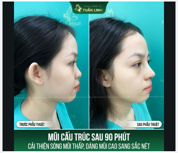 Đừng để chiếc mũi thấp tẹt khiến bạn nhạt nhòa và tự ti nữa!