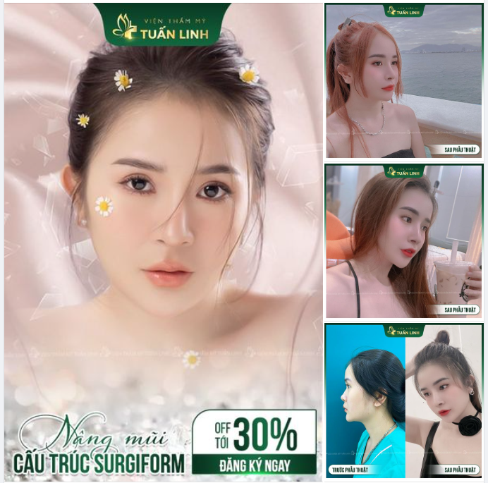 Nâng mũi cấu trúc giảm Surgiform sâu mừng Đại Lễ 30.4-1.5