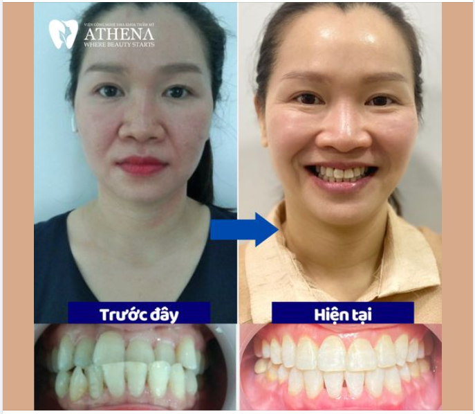 TỎA SÁNG NỤ CƯỜI MỚI - TẠM BIỆT KHỚP CẮN NGƯỢC