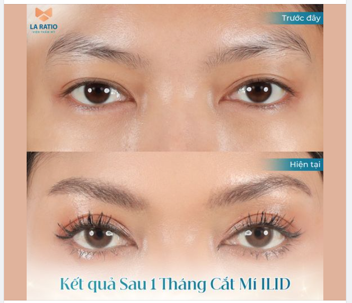 KẾT QUẢ SAU 1 THÁNG CẮT MÍ ILID