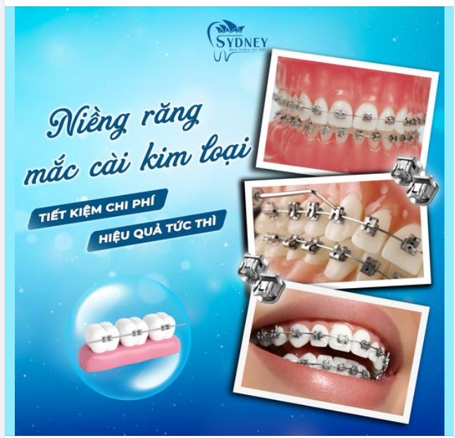 NIỀNG RĂNG MẮC CÀI KIM LOẠI - TIẾT KIỆM CHI PHÍ, HIỆU QUẢ TỨC THÌ