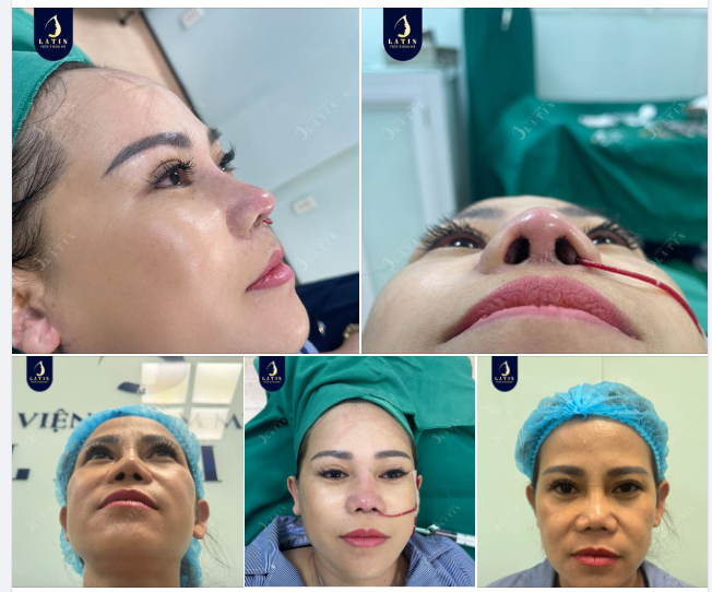 Mũi tái cấu trúc cho cô khách đến từ Gia Lai