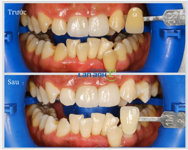 Mặc dù răng bạn có thể không đều, nhưng tẩy trắng răng cũng sẽ giúp cải thiện được nụ cười của bạn!