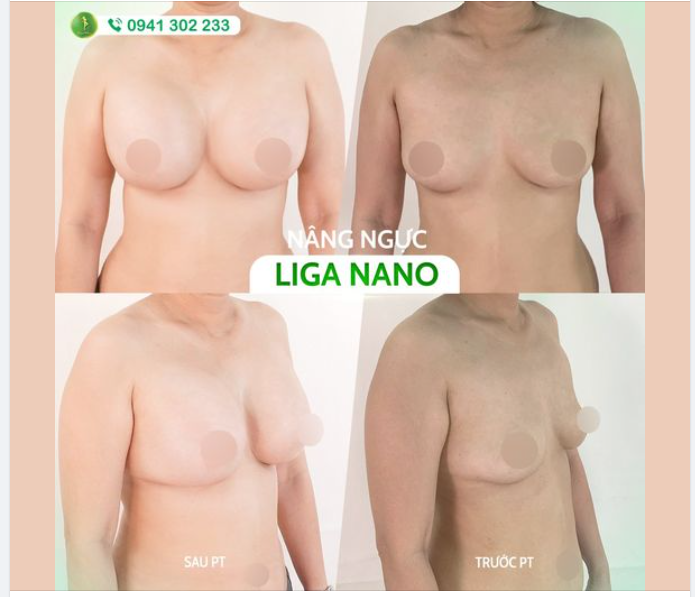 BÍ KÍP ĐỂ SỞ HỮU VÒNG 1 ĐẸP ĐÚNG CHUẨN