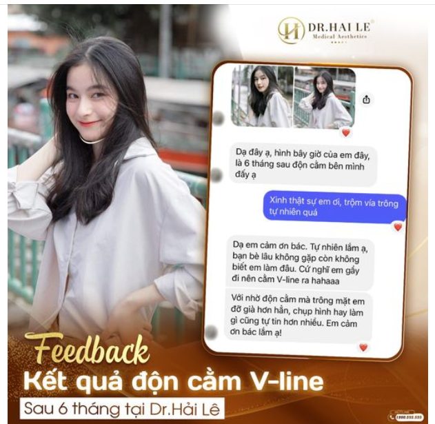 Feedback từ bạn khách sau 6 tháng độn cằm V-line tại Dr.Hải Lê.