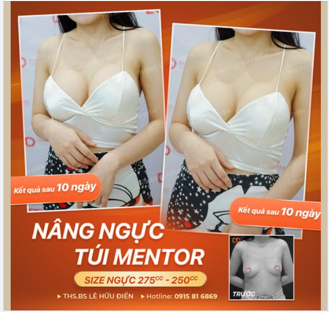 V1 nhỏ lệch, mất cân đối, khe ngực xa nhau Khắc phục chỉ trong 60 phút.