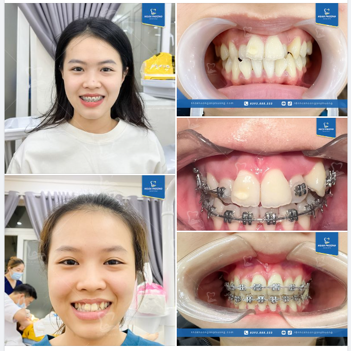 Niềng răng có thể xinh đẹp đến nhường nào?