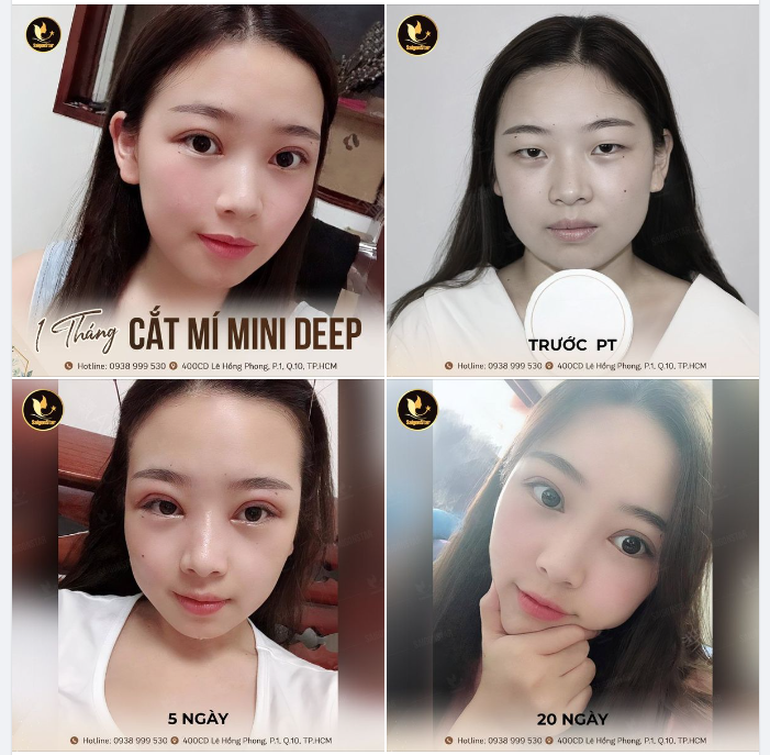 FEEDBACK 1 THÁNG CẮT MÍ MINIDEEP