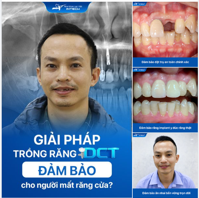 TRỒNG RĂNG CỬA BẰNG GIẢI PHÁP DCT ĐẢM BẢO RĂNG BỀN CHẮC THẨM MỸ NHƯ RĂNG THẬT