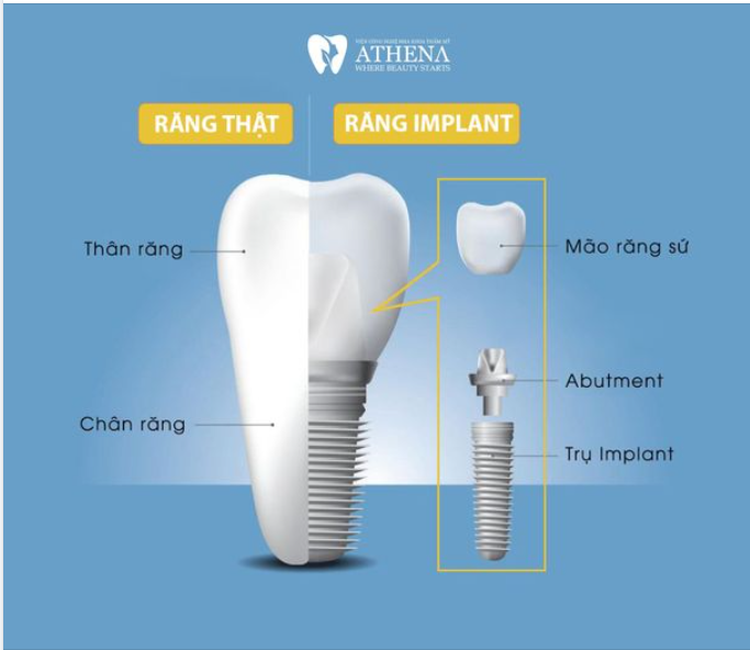 BẠN CÓ BIẾT VỀ RĂNG IMPLANT KHÔNG?