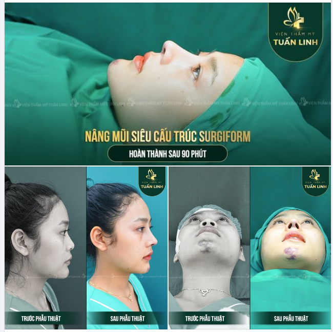 Chỉ 90 phút sở hữu ngay Dáng Mũi siêu đẹp, siêu nhẹ - Kiêu kỳ chuẩn Idol.