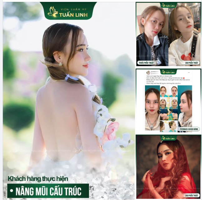 Fedback Nâng mũi - Dáng mũi đẹp thay đổi cả gương mặt!!