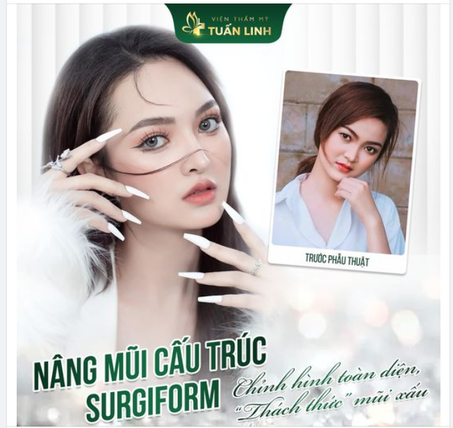 Nâng mũi cấu trúc Surgiform - Sự lựa chọn hoàn hảo cho dáng mũi đẹp!!