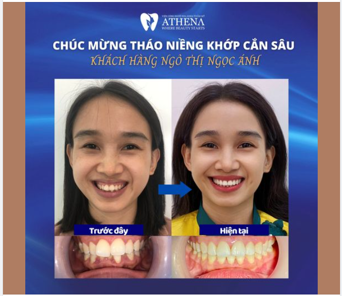 LÝ DO BẠN MUỐN NIỀNG RĂNG NHƯNG CHƯA THỰC HIỆN